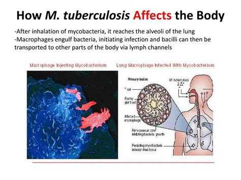 xbree.tb|how does tuberculosis affect the respiratory system.